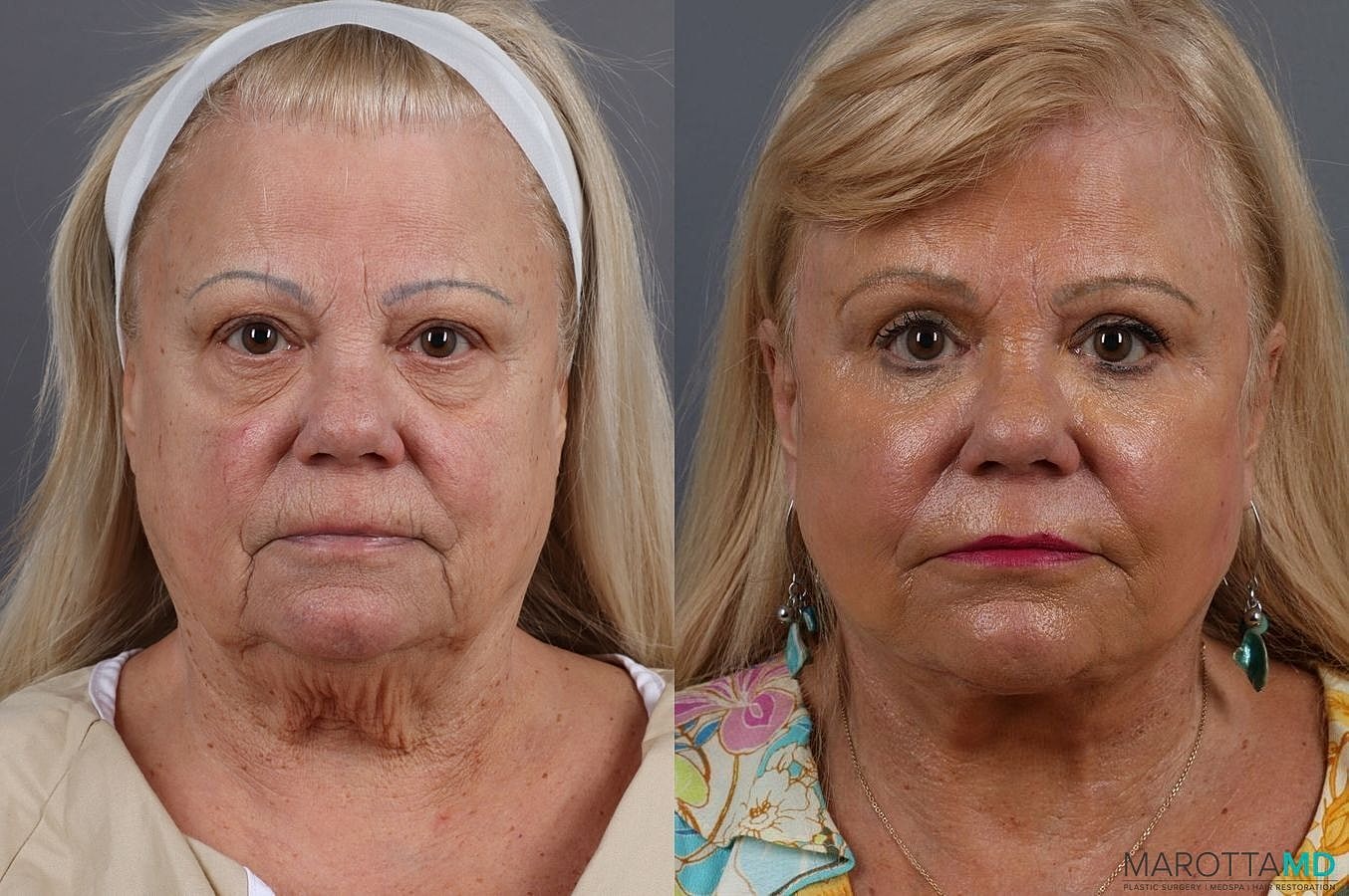 Laser Skin Resurfacing Before & After