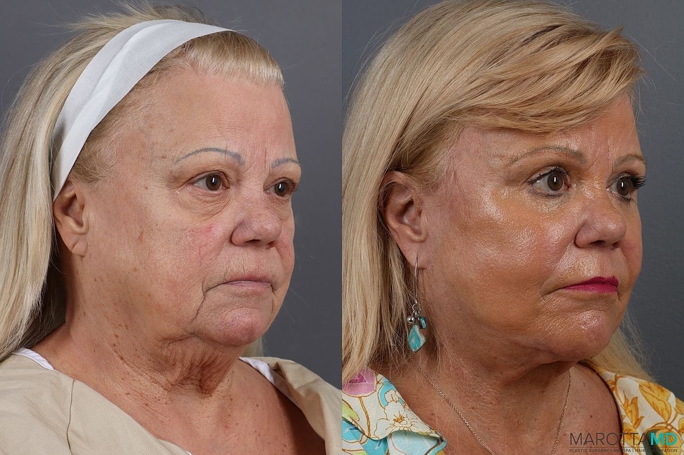 Laser Skin Resurfacing Before & After