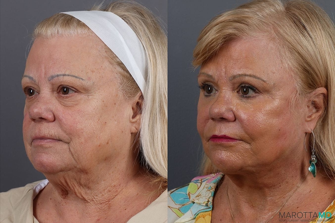 Laser Skin Resurfacing Before & After