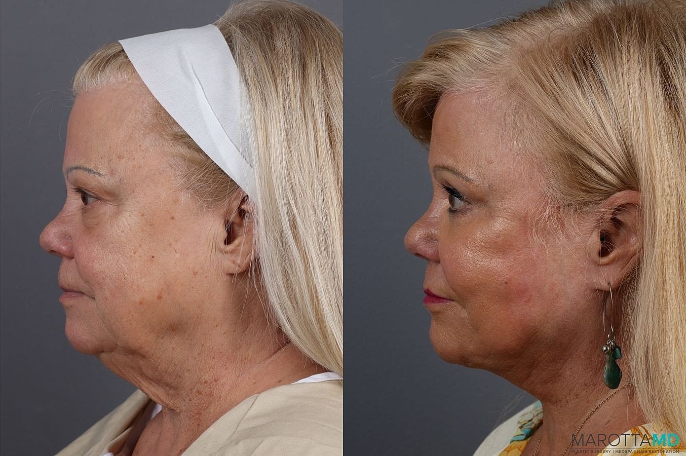 Laser Skin Resurfacing Before & After