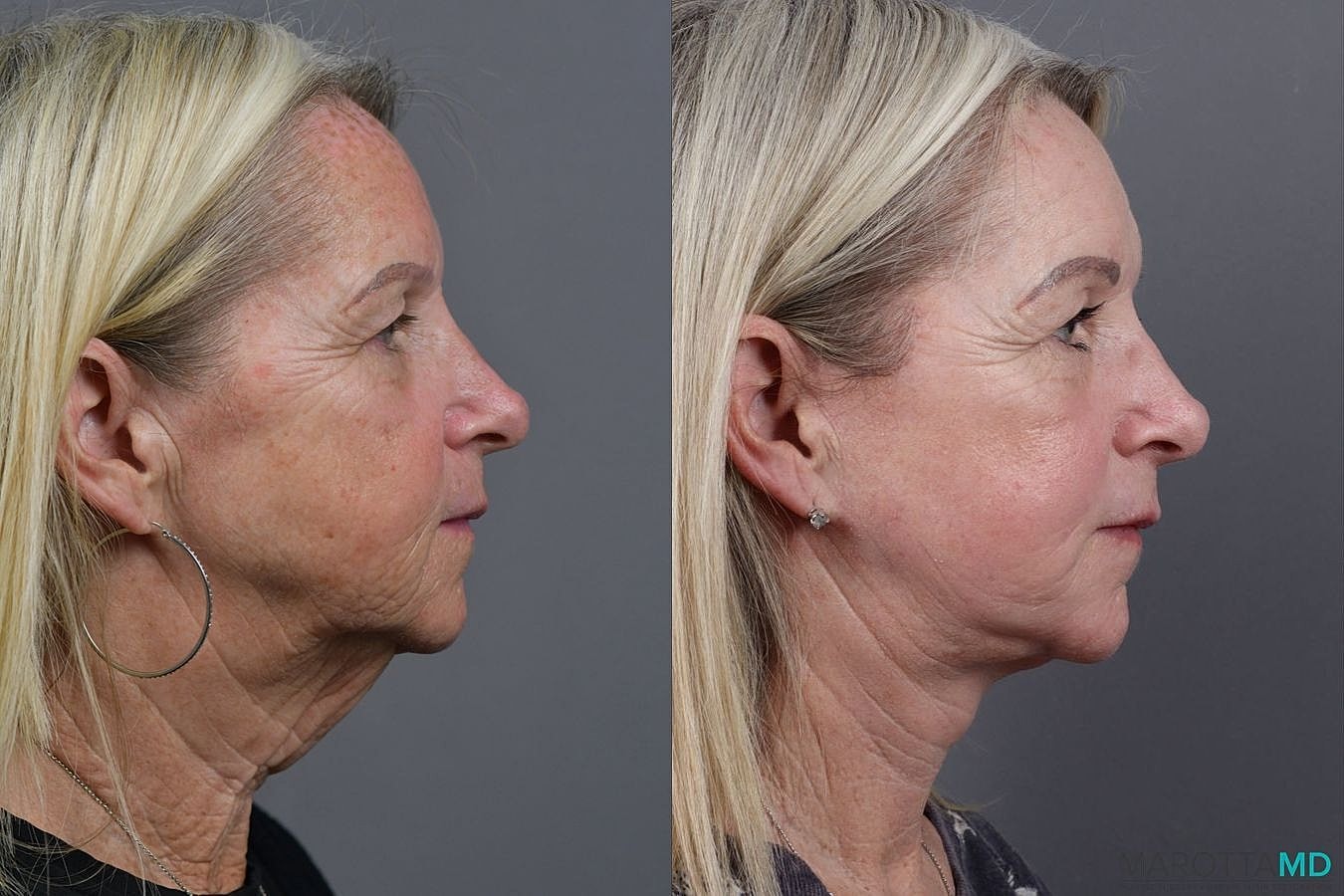 Laser Skin Resurfacing Before & After