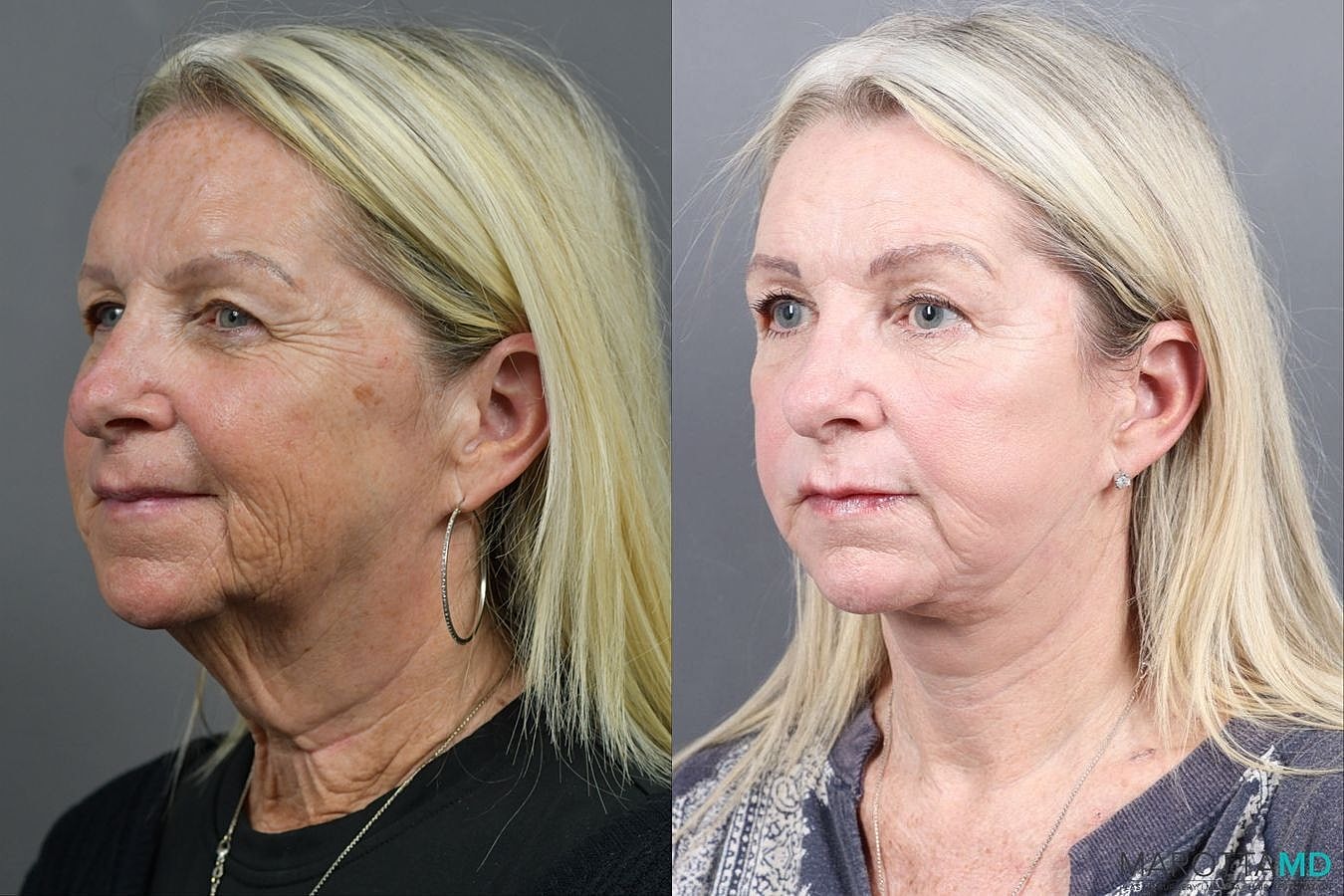 Laser Skin Resurfacing Before & After
