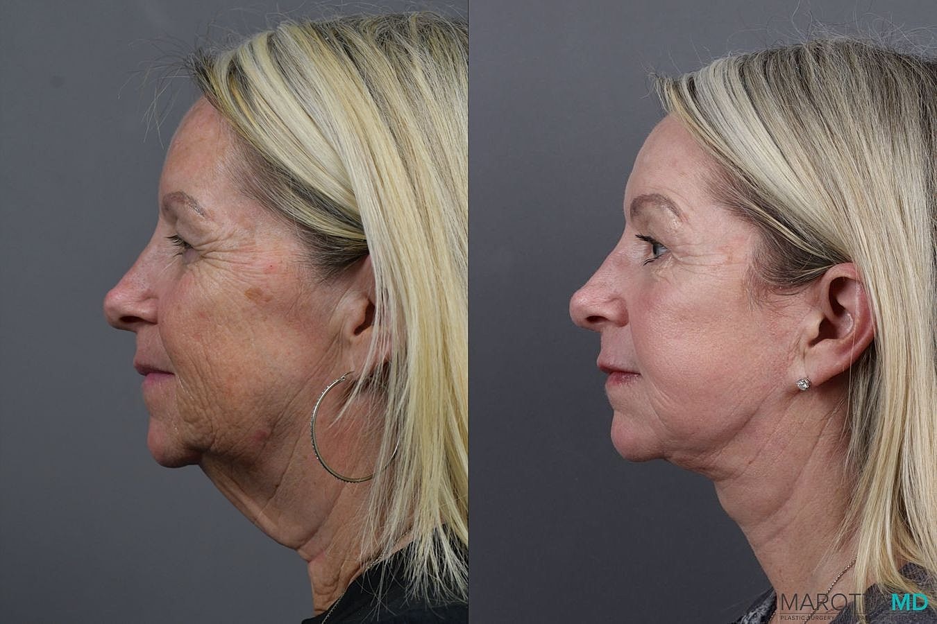 Laser Skin Resurfacing Before & After