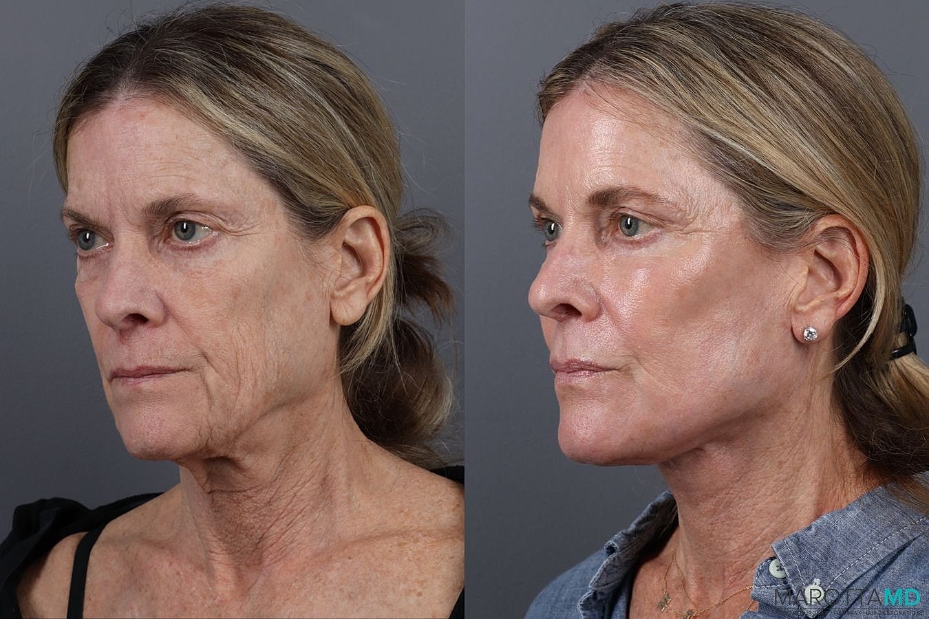 Laser Skin Resurfacing Before & After