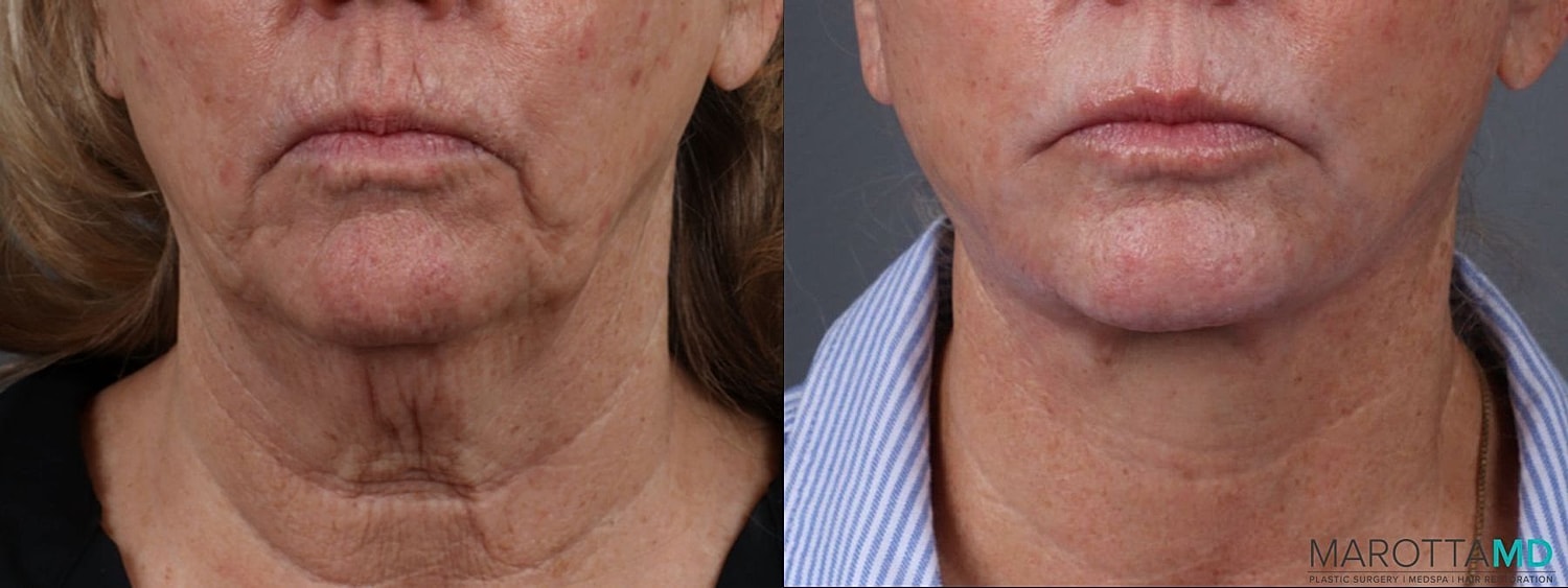 Laser Skin Resurfacing Before & After