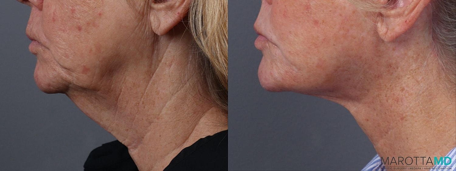 Laser Skin Resurfacing Before & After