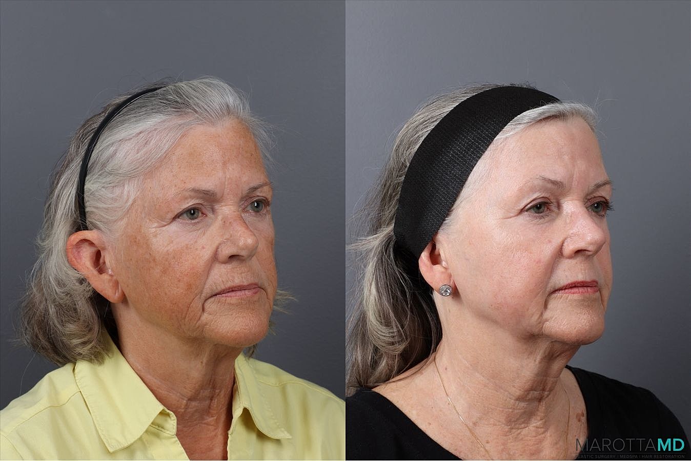 Laser Skin Resurfacing Before & After