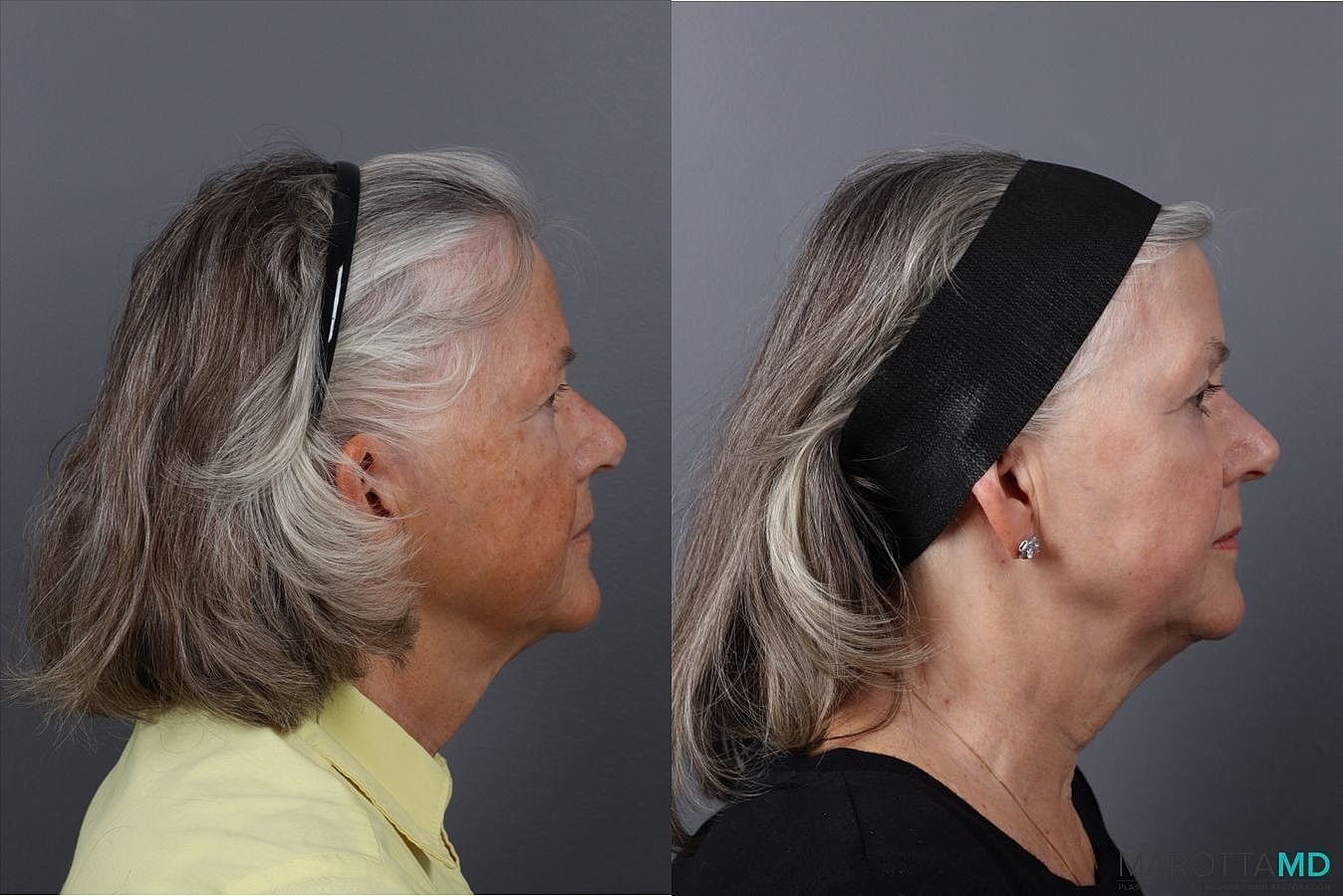 Laser Skin Resurfacing Before & After