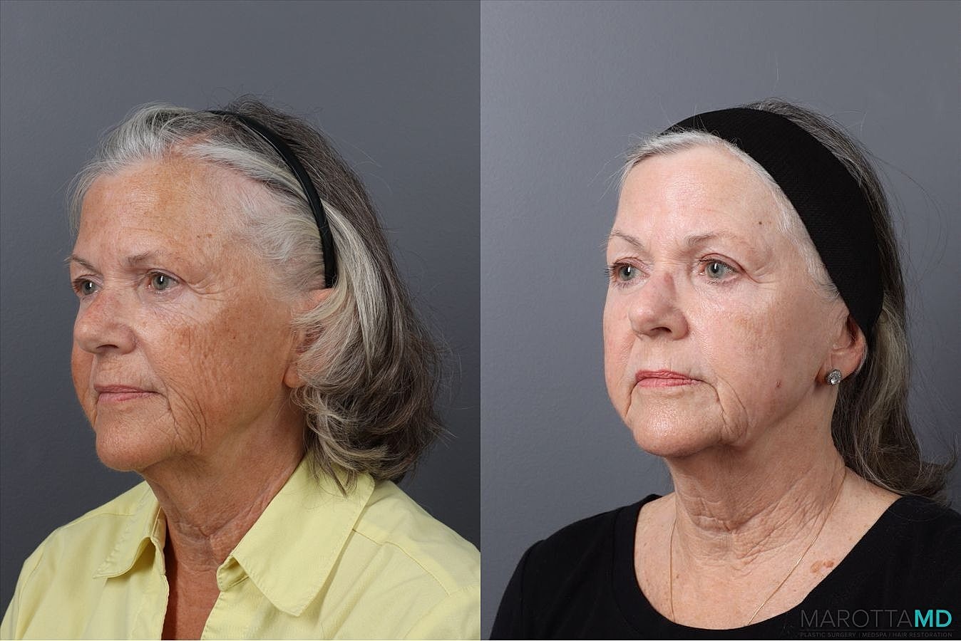 Laser Skin Resurfacing Before & After