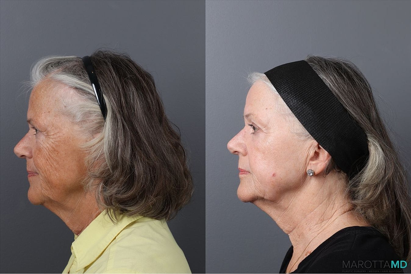 Laser Skin Resurfacing Before & After
