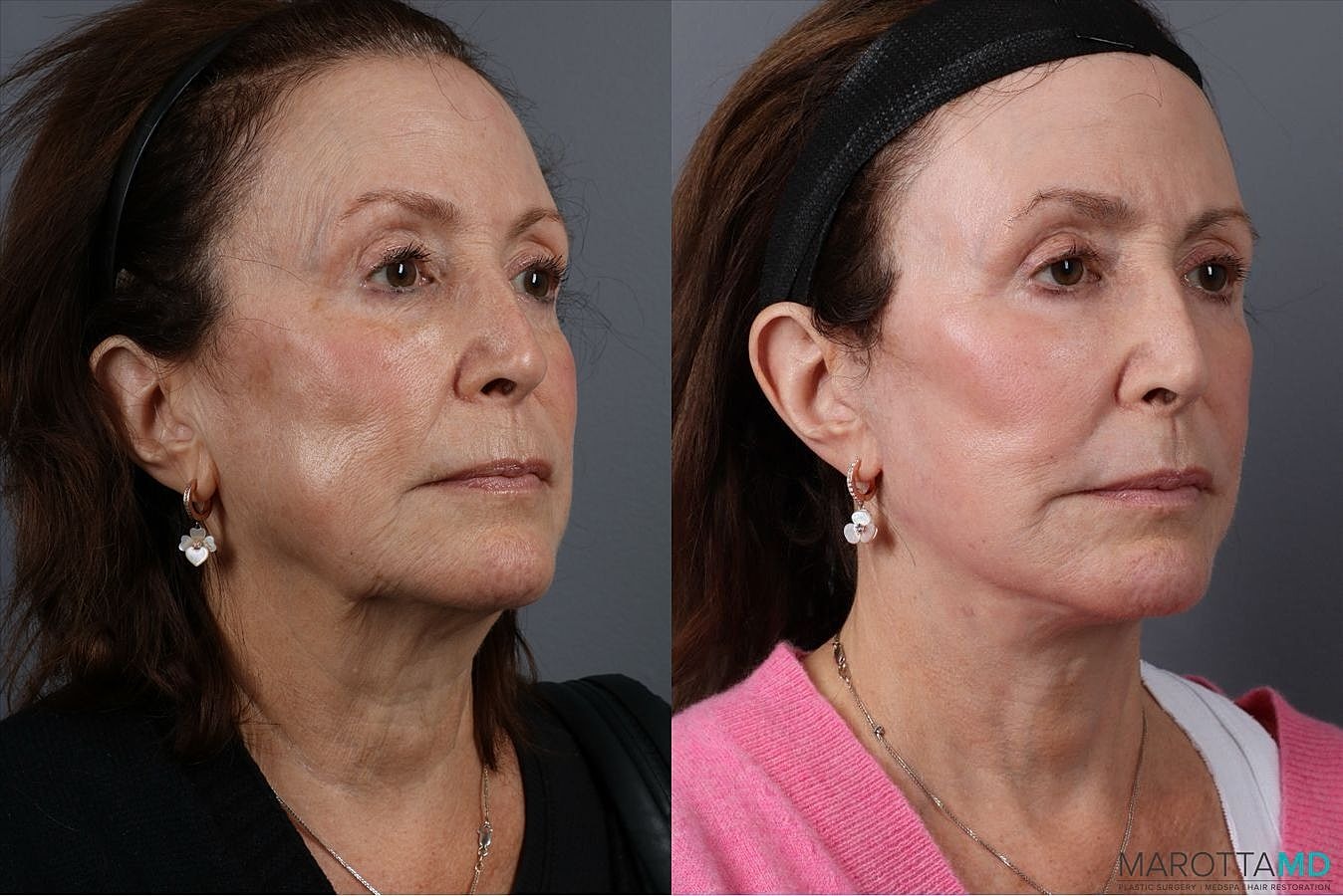 Laser Skin Resurfacing Before & After
