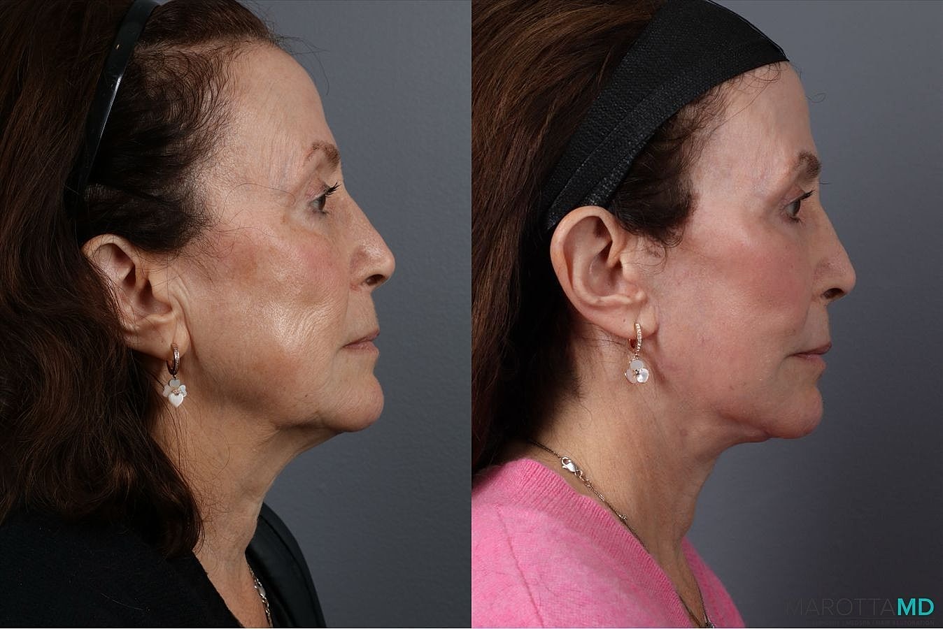 Laser Skin Resurfacing Before & After