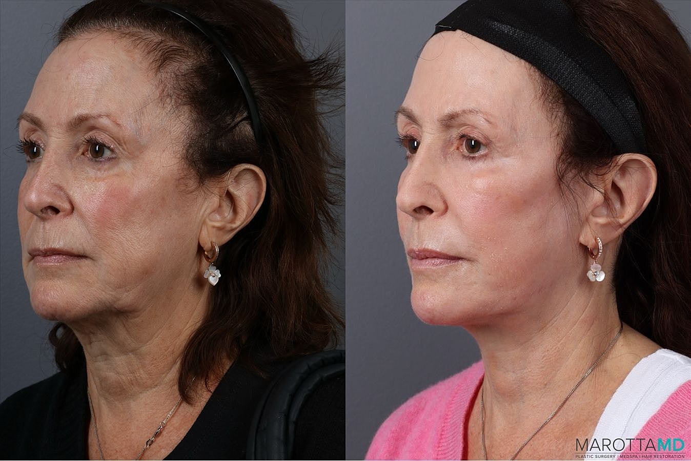 Laser Skin Resurfacing Before & After