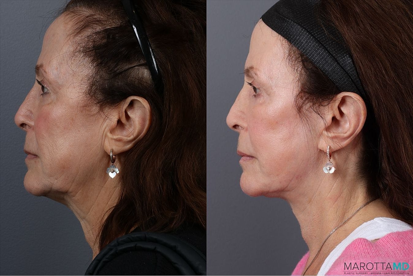 Laser Skin Resurfacing Before & After