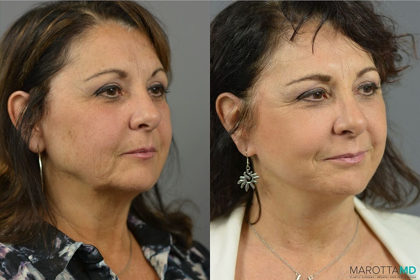 Laser Skin Resurfacing Before & After