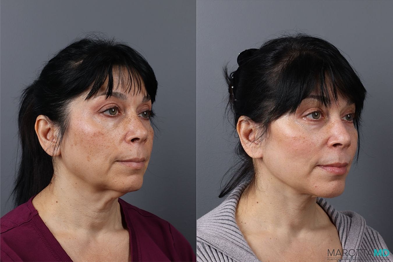 Laser Skin Resurfacing Before & After