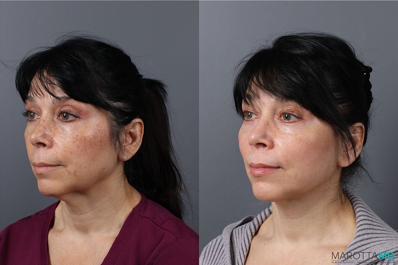Laser Skin Resurfacing Before & After