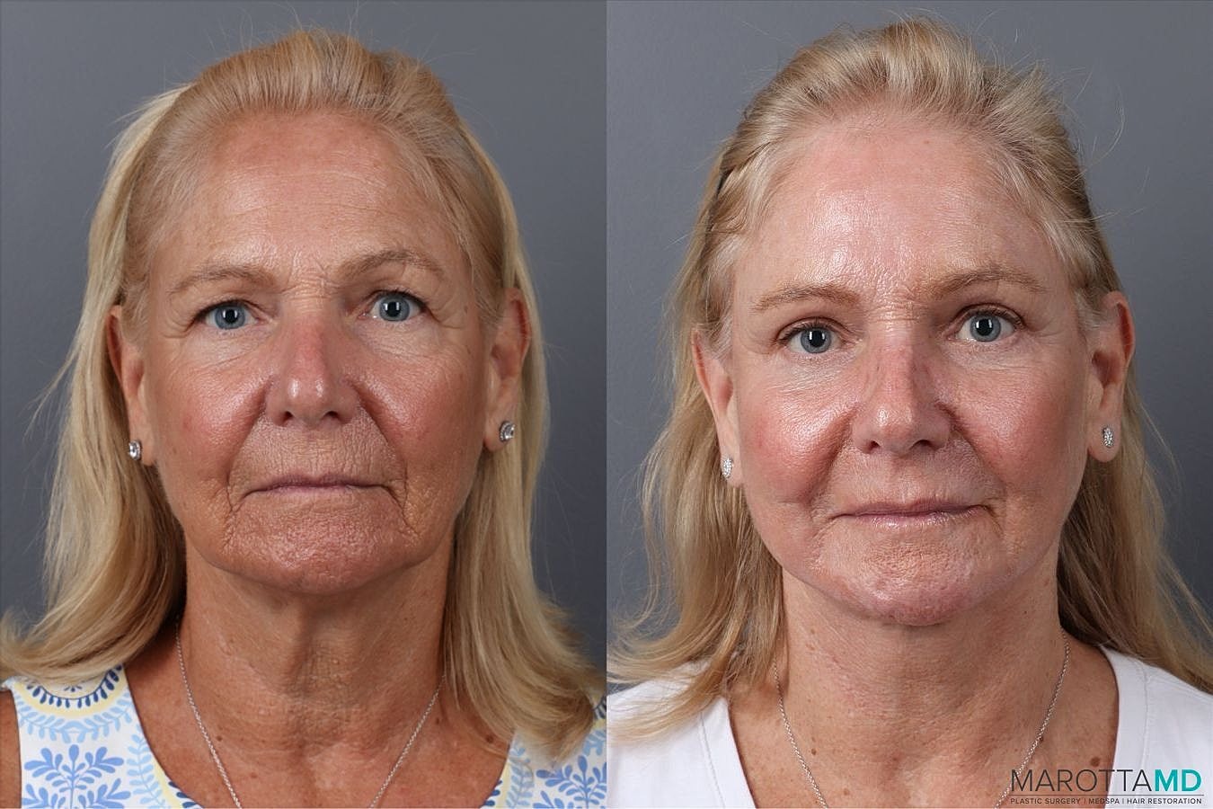 Laser Skin Resurfacing Before & After