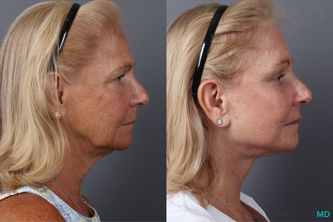 Laser Skin Resurfacing Before & After