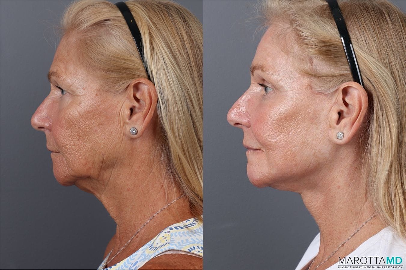 Laser Skin Resurfacing Before & After