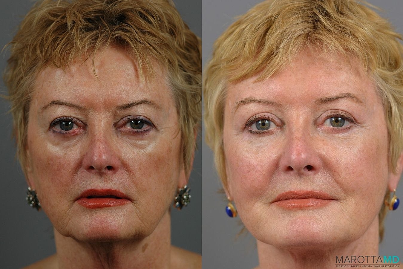 Eyelid Lift Before & After