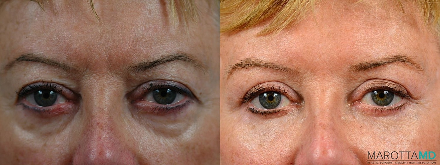 Eyelid Lift Before & After