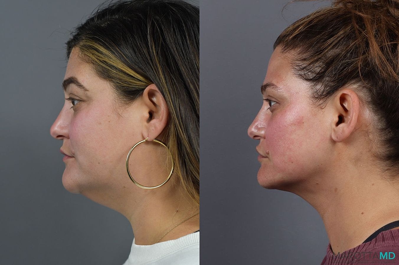 Liposuction Of The Neck Before & After