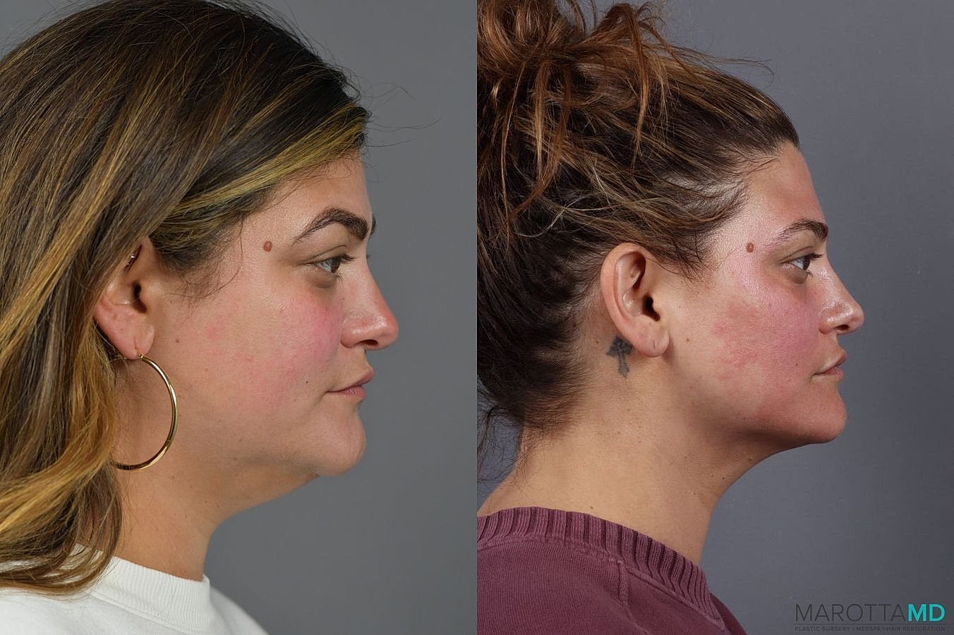 Liposuction Of The Neck Before & After