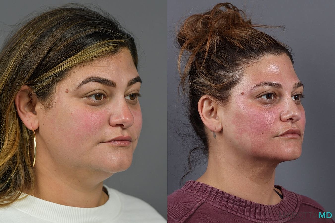 Liposuction Of The Neck Before & After