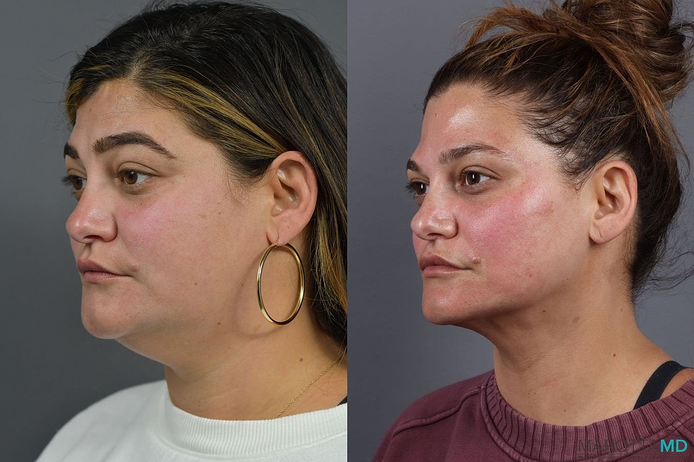 Liposuction Of The Neck Before & After