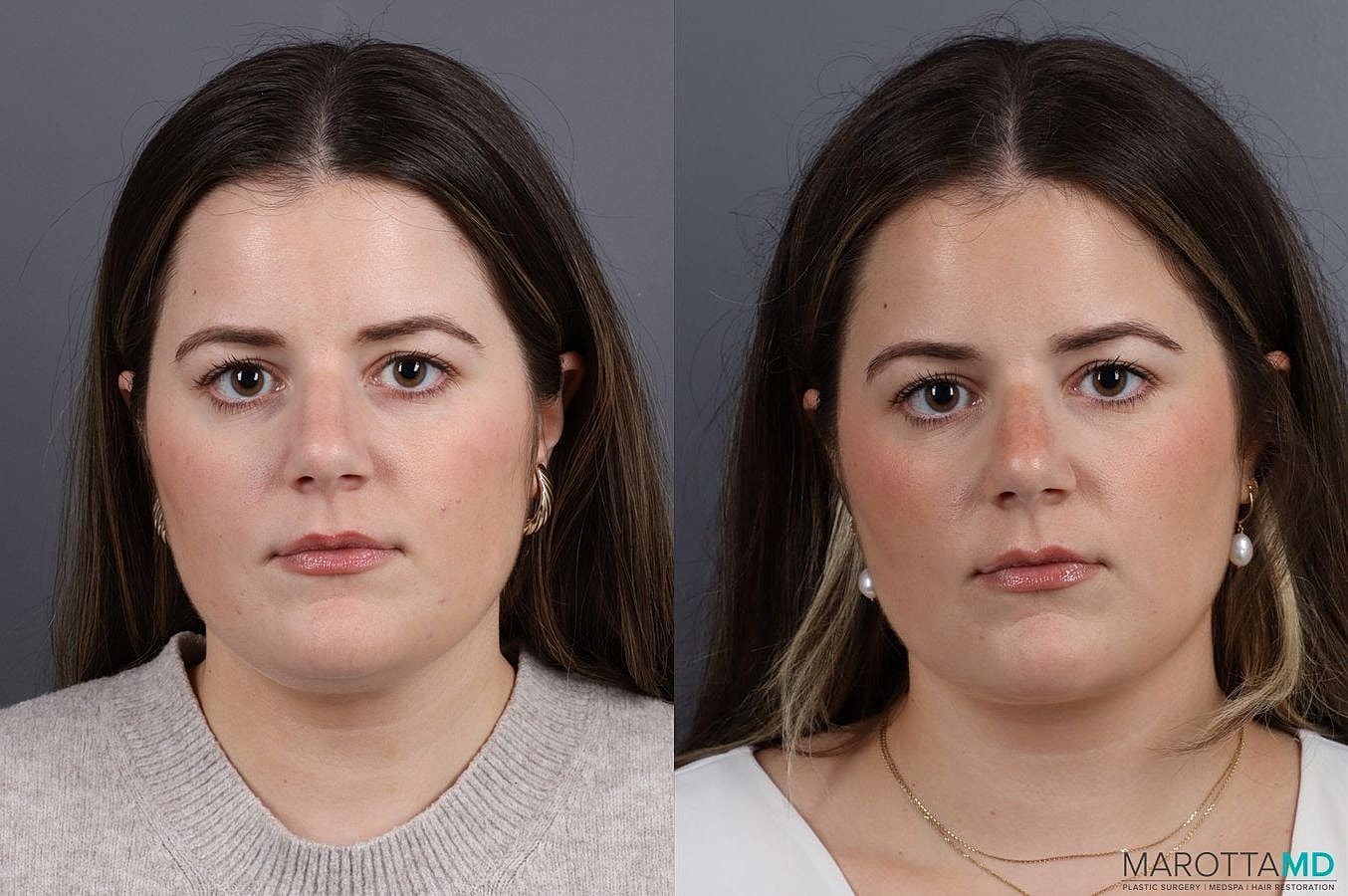 Liposuction Of The Neck Before & After