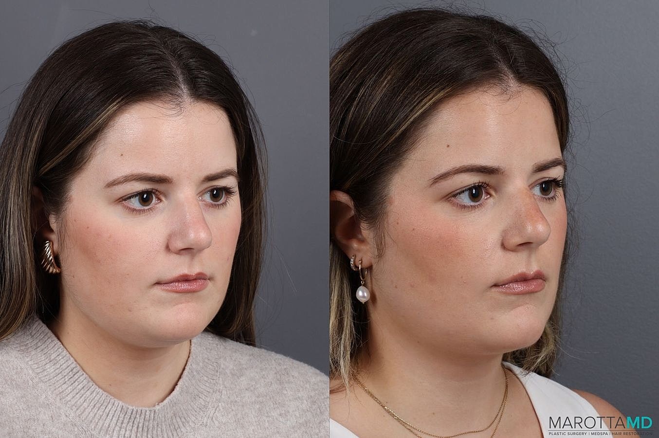 Liposuction Of The Neck Before & After