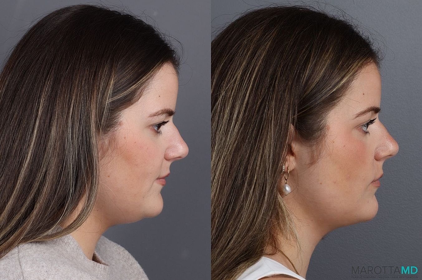 Liposuction Of The Neck Before & After
