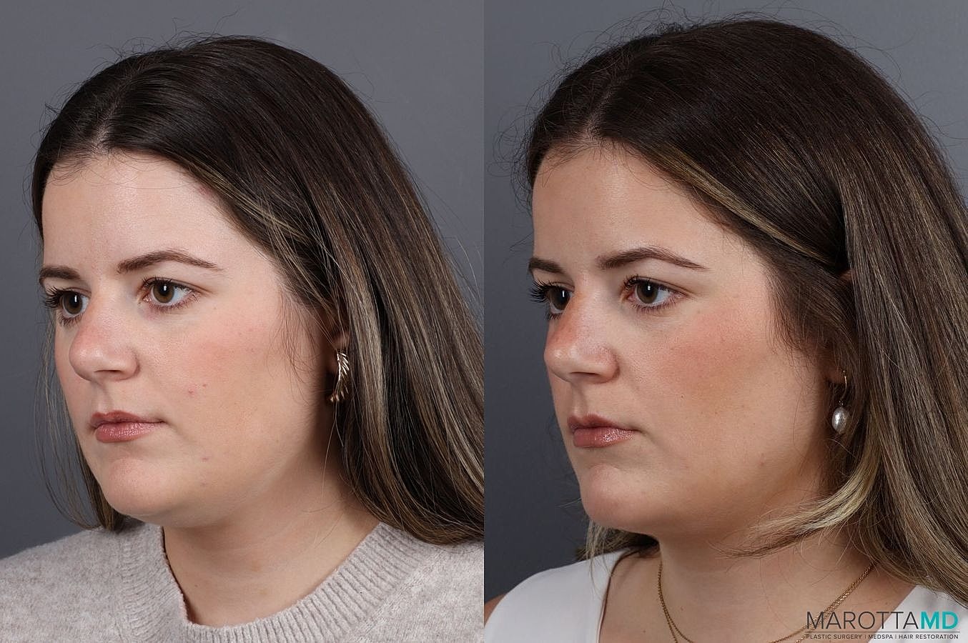 Liposuction Of The Neck Before & After