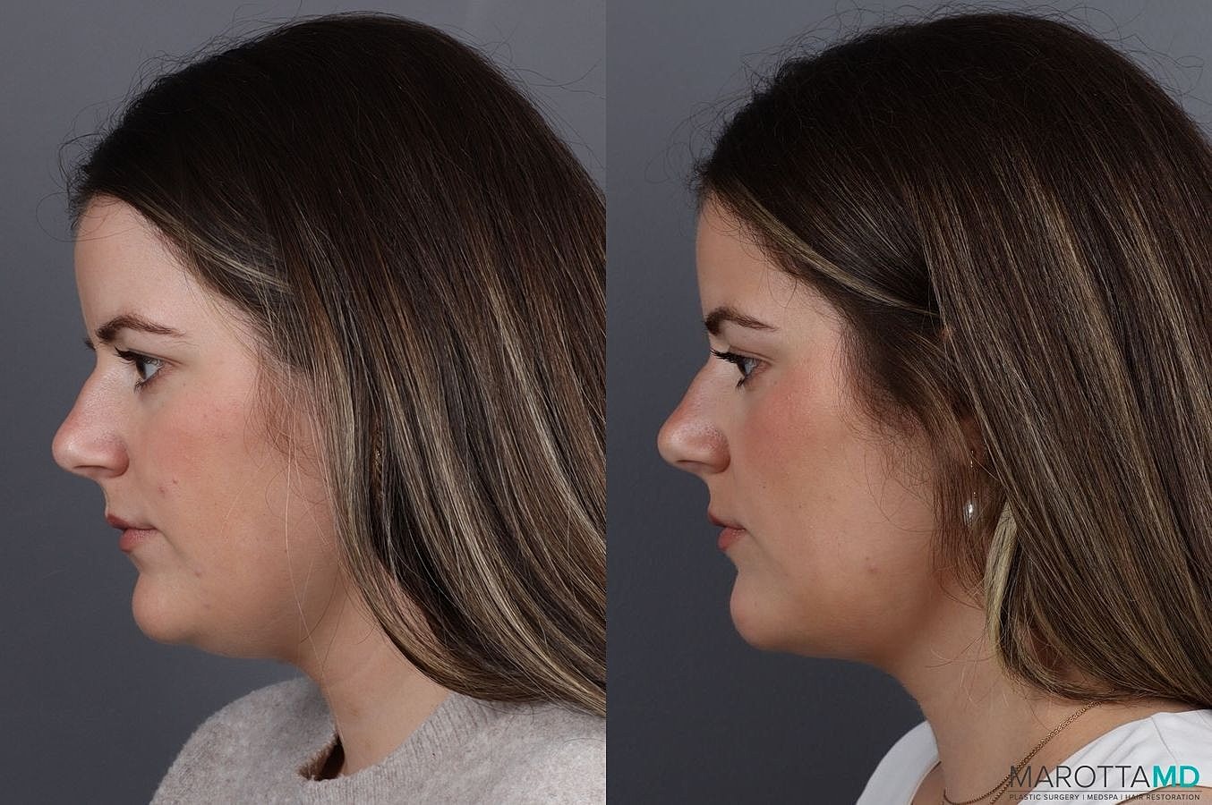 Liposuction Of The Neck Before & After