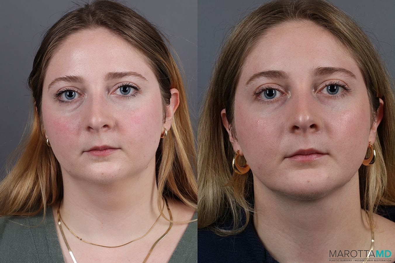 Liposuction Of The Neck Before & After