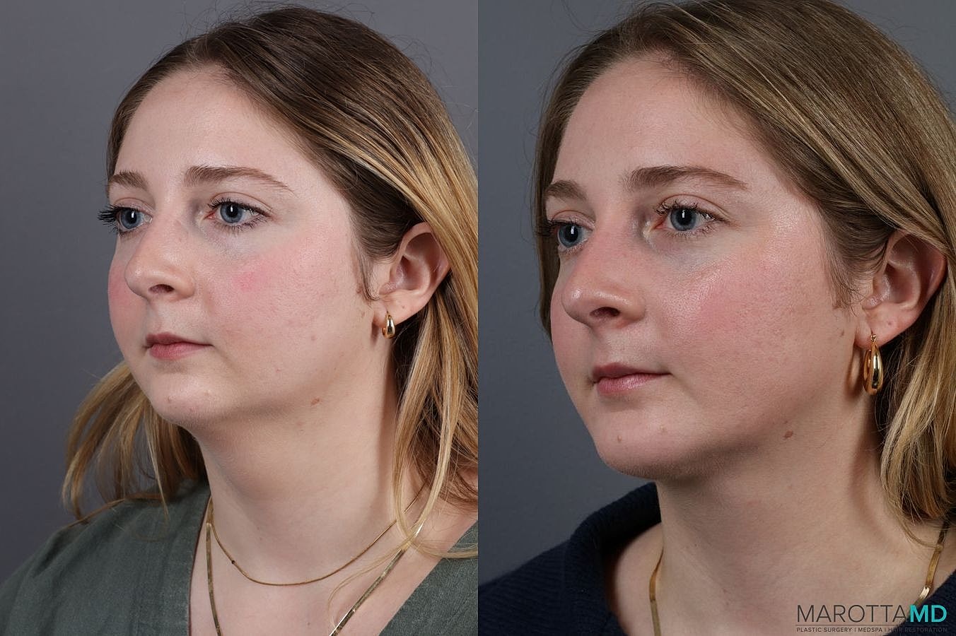 Liposuction Of The Neck Before & After