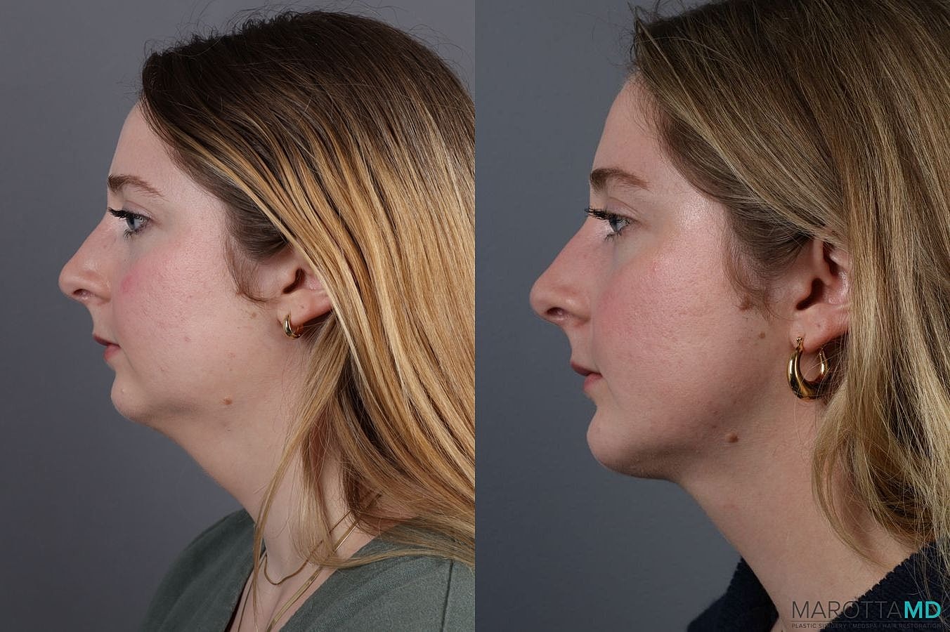 Liposuction Of The Neck Before & After