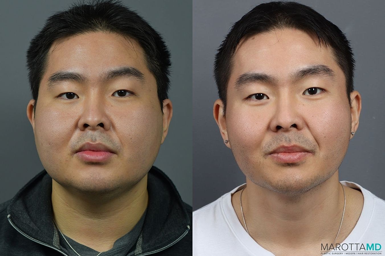 Liposuction Of The Neck Before & After