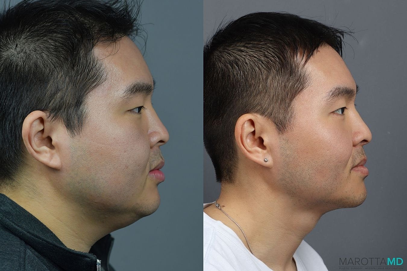 Liposuction Of The Neck Before & After