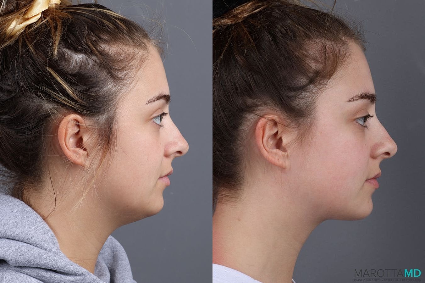Liposuction Of The Neck Before & After