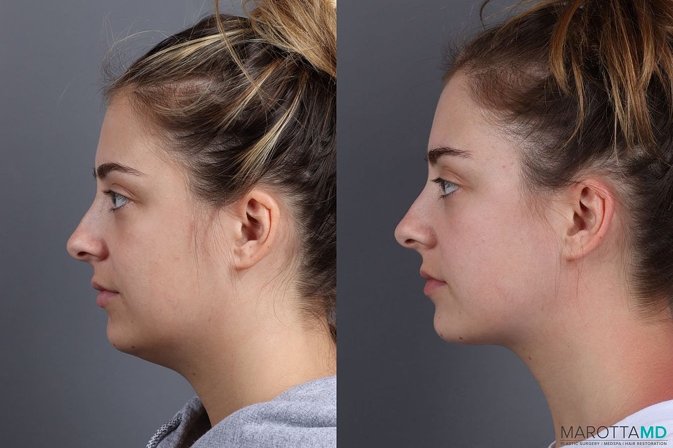 Liposuction Of The Neck Before & After