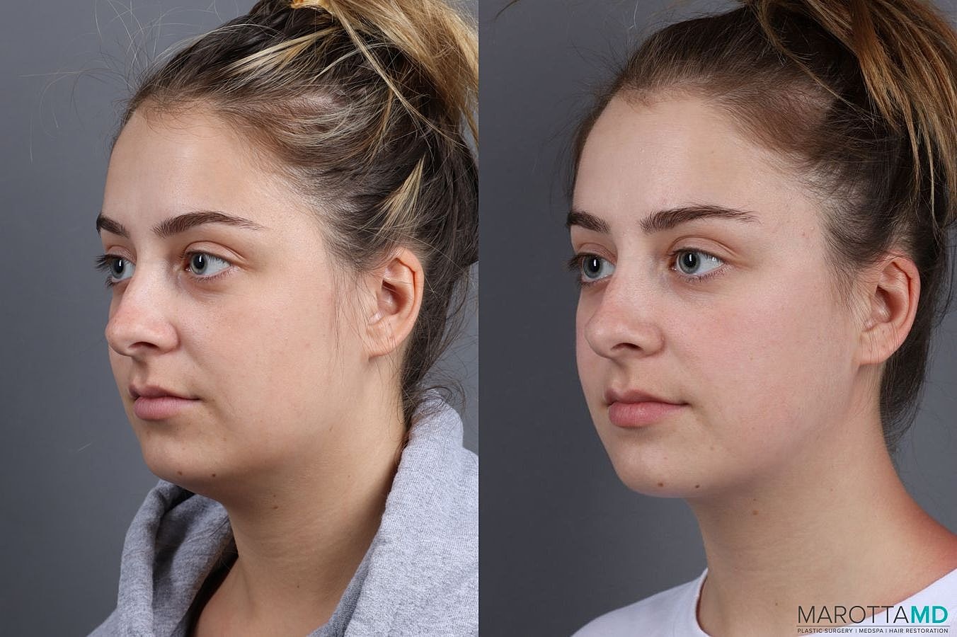 Liposuction Of The Neck Before & After