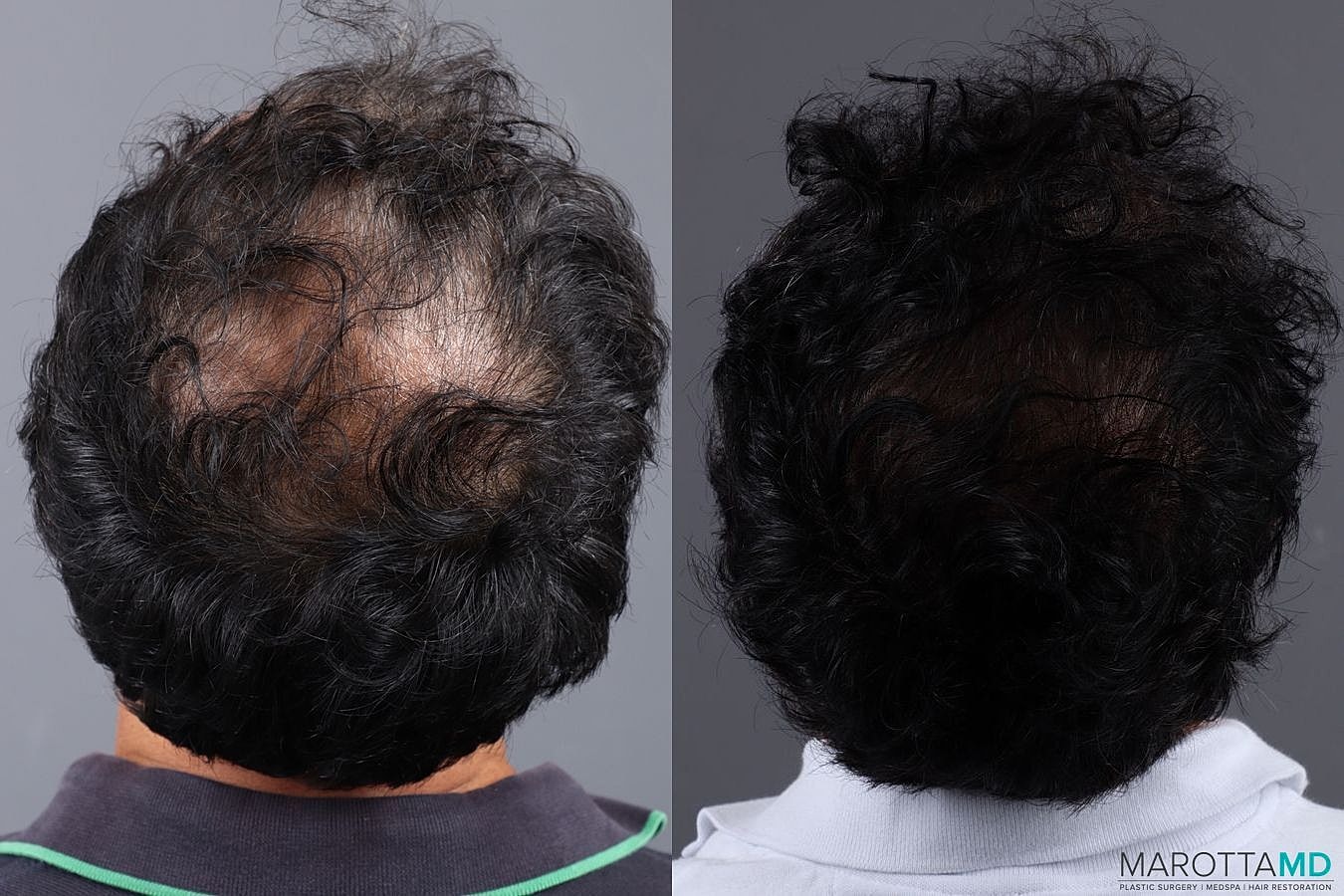 Hair Transplants Before & After
