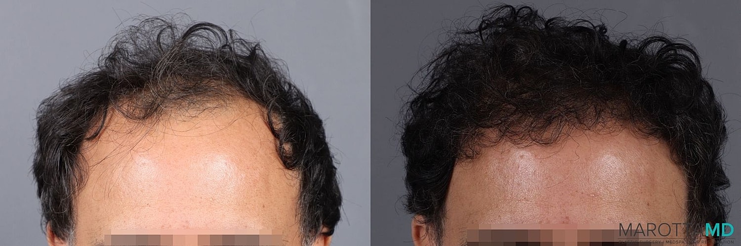 Hair Transplants Before & After