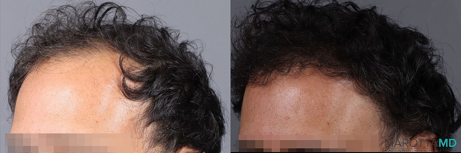 Hair Transplants Before & After
