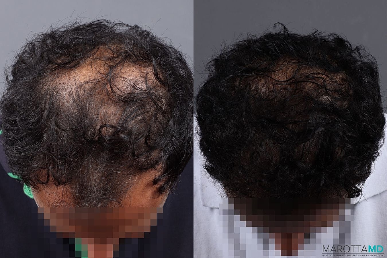 Hair Transplants Before & After