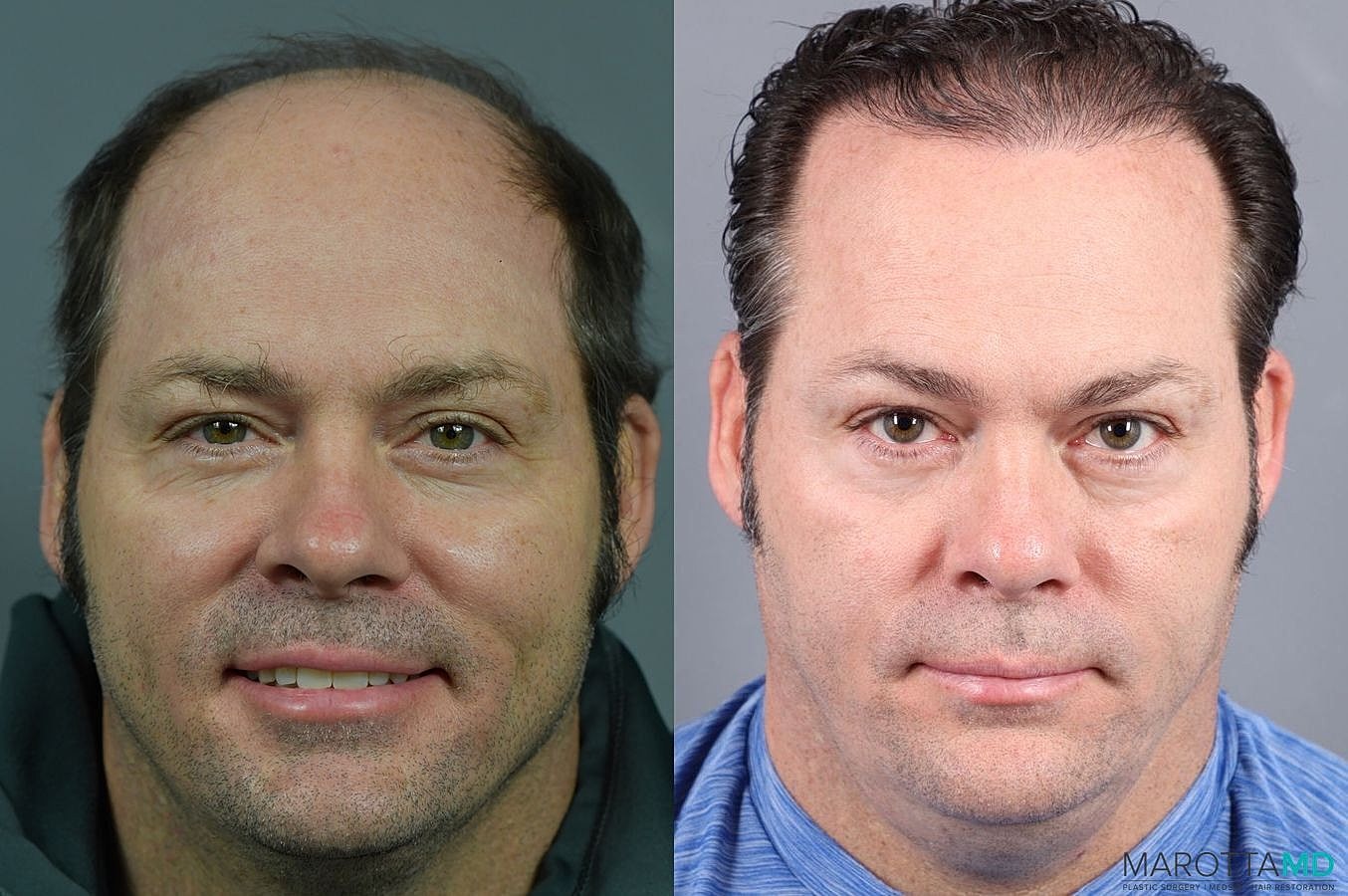 Hair Transplants Before & After