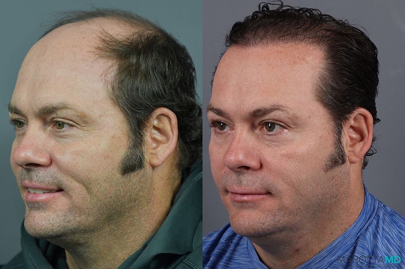 Hair Transplants Before & After