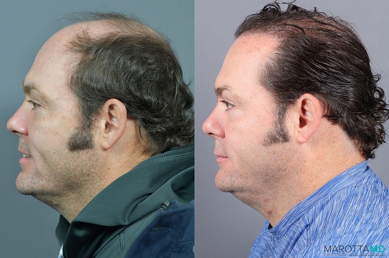Hair Transplants Before & After